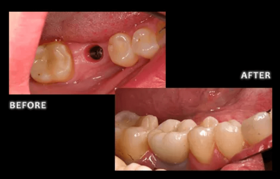 Implant result 1