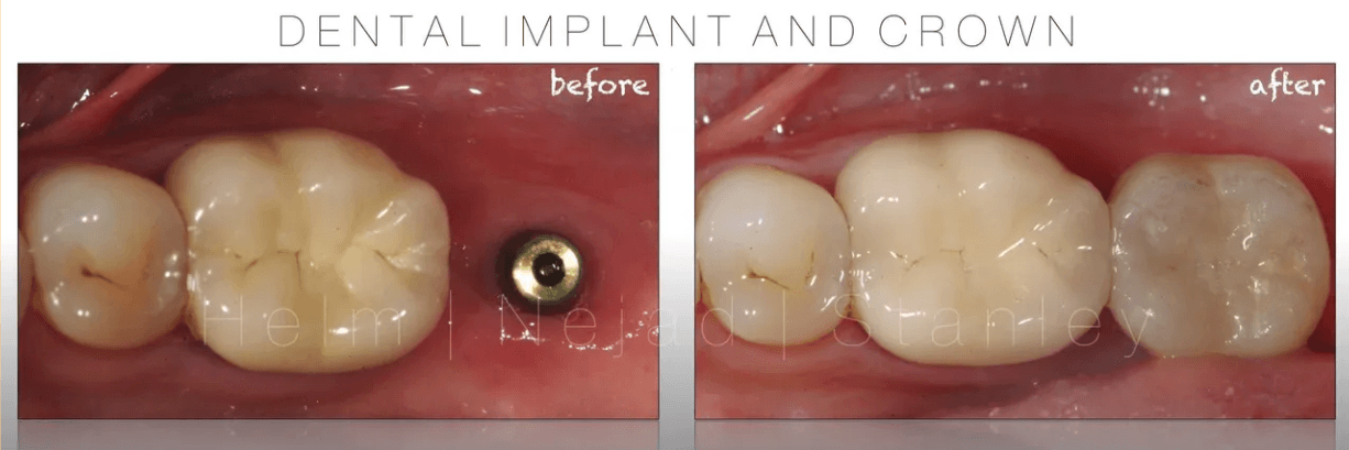 Implant result 3