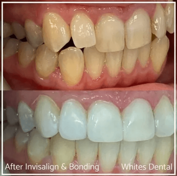 Invisalign result 3